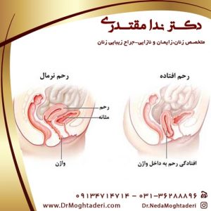 عکس افتادگی رحم