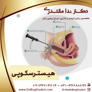 هیستروسکوپی